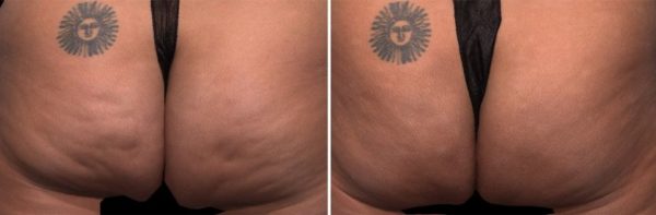 Before And After Treatment | Absolute Health Care | Newnan GA