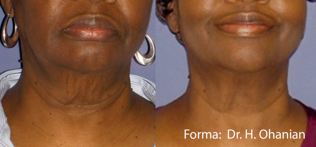 Before And After Neck| Absolute Health care | Newnan GA