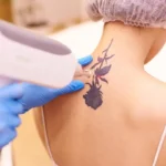 Laser Tattoo Removal by Absolute Health And Wellness in Newnan GA