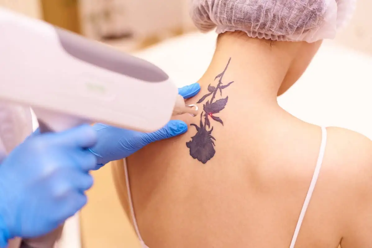 Laser Tattoo Removal by Absolute Health And Wellness in Newnan GA