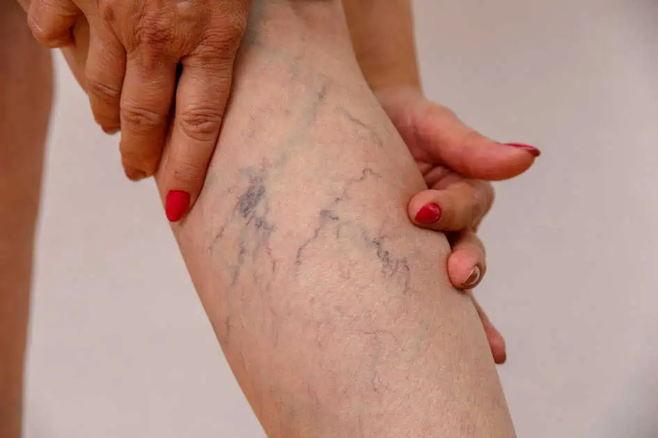 Spider Veins by Absolute Healthcare of Ga inc in Newnan, GA