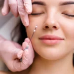 woman receiving a PDO thread lift procedure in Newnan, Georgia