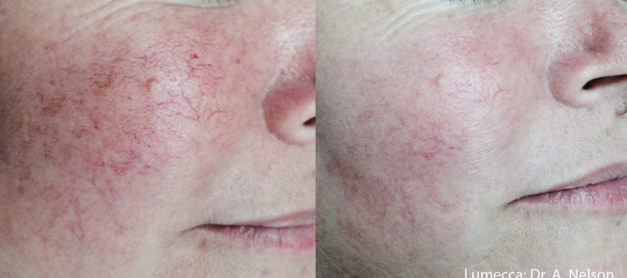 TB Lumecca | Absolute Health Care | Newnan GA