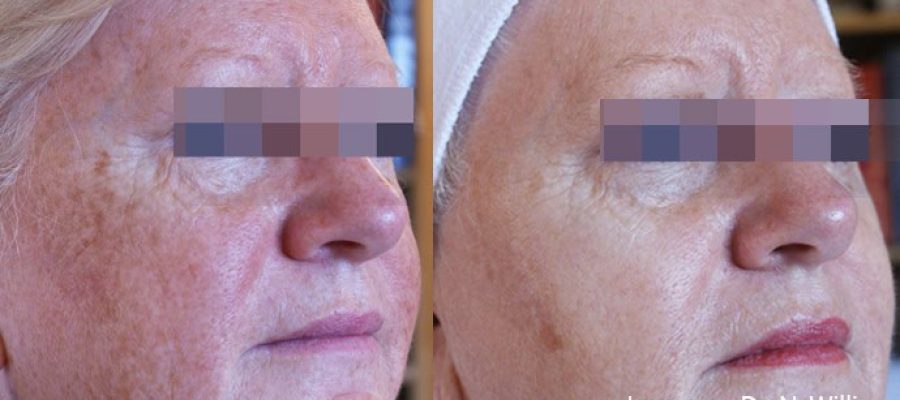 Lumecca – IPL Photo Facial | Absolute Health Care | Newnan GA