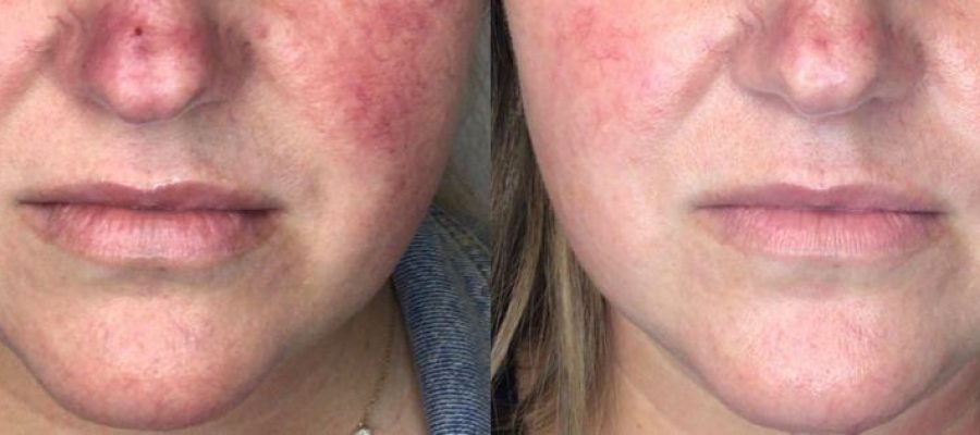 Before And After Treatment | Absolute Health Care | Newnan GA