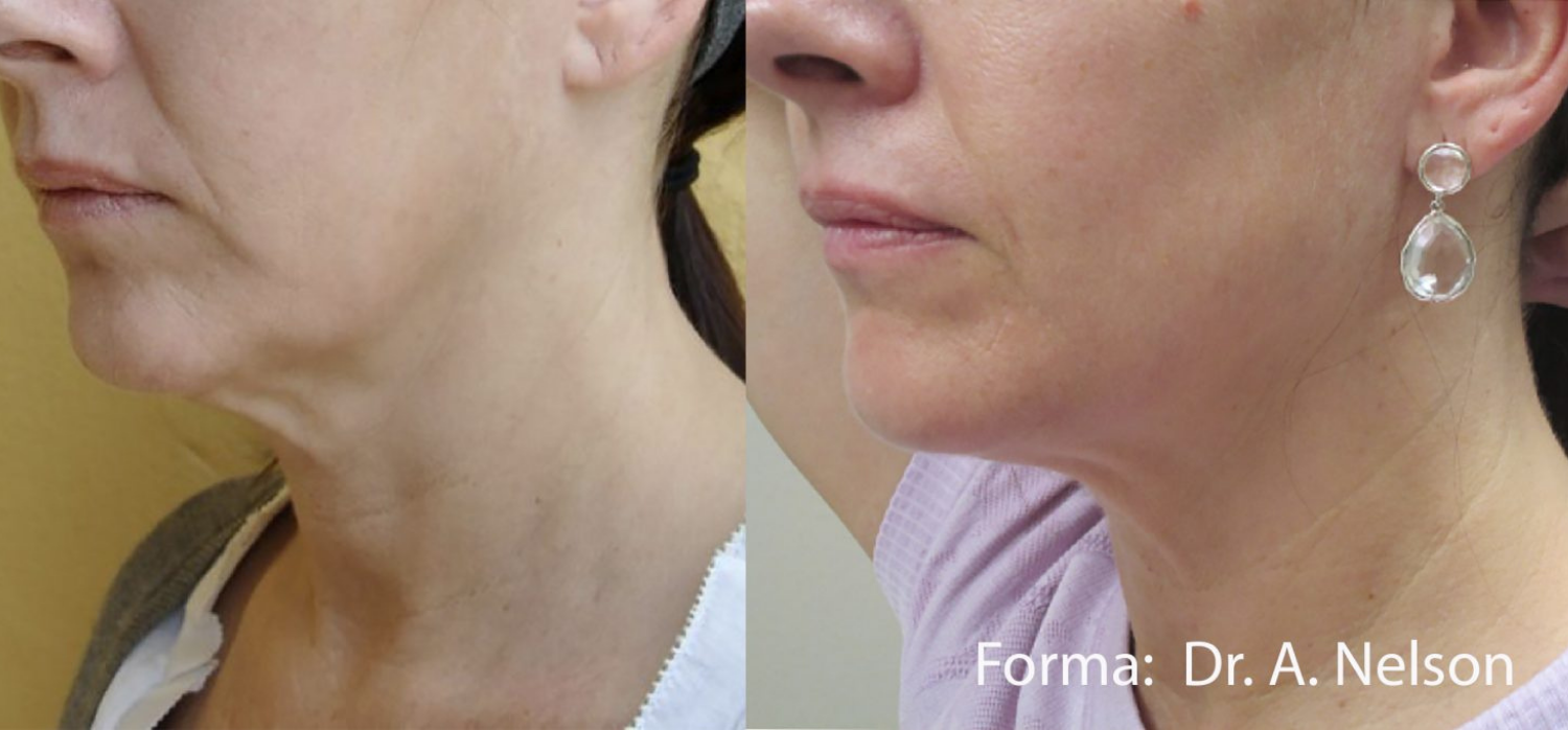 Before & After Forma | Absolute Health Care | Newnan GA