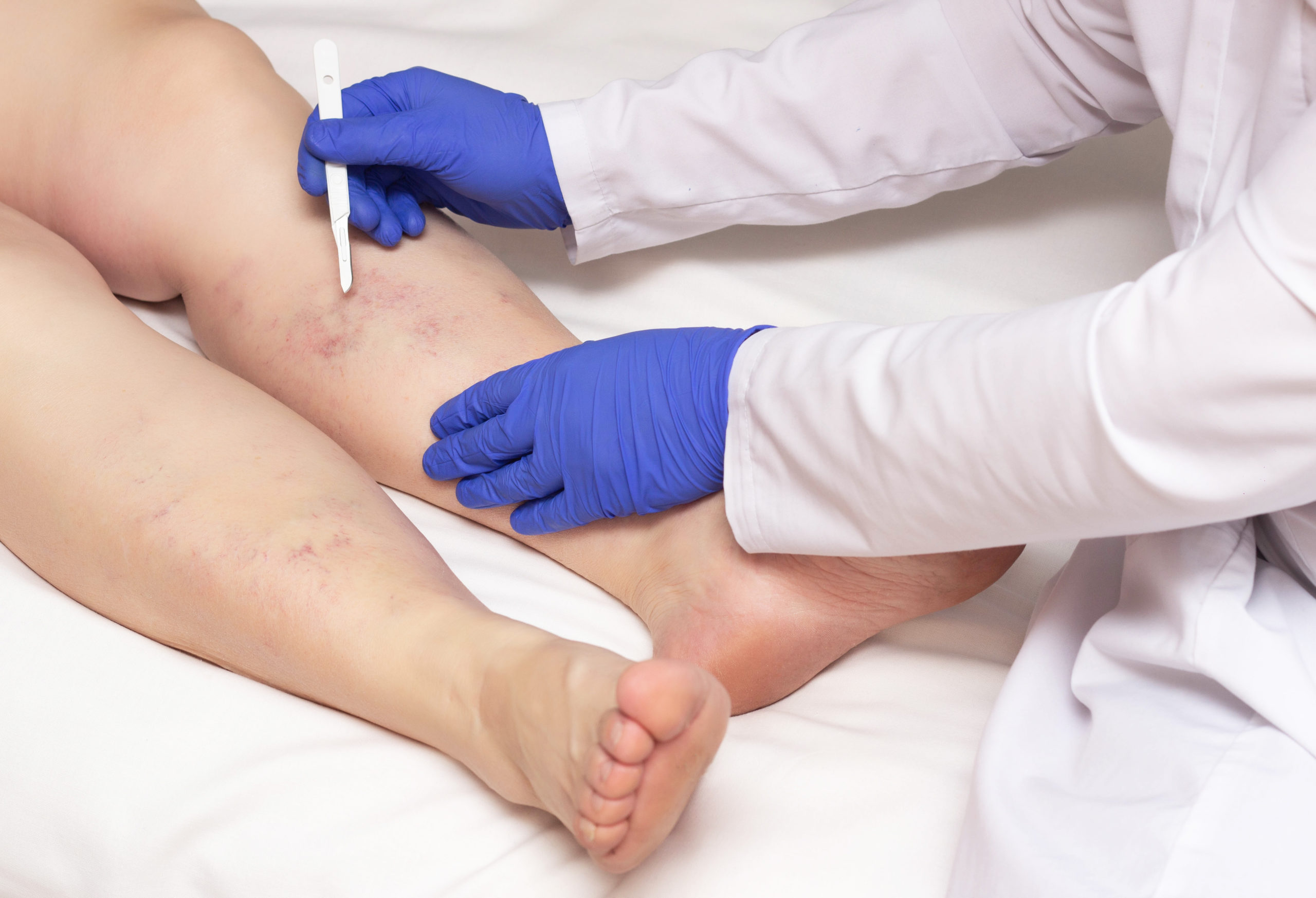 Laser Vein Removal | Absolute Health Care | Newnan GA