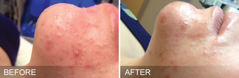 Before And After Treatment | Absolute Health Care | Newnan GA