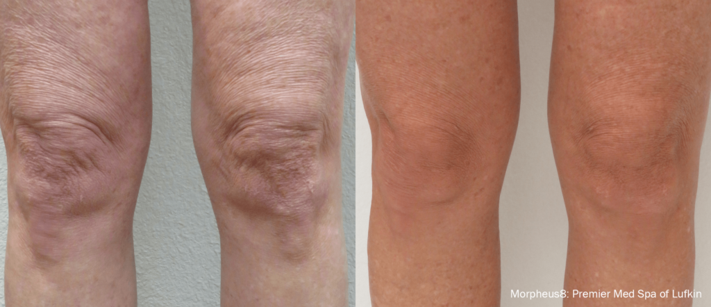 Before And After Morpheus | Absolute Health care | Newnan GA