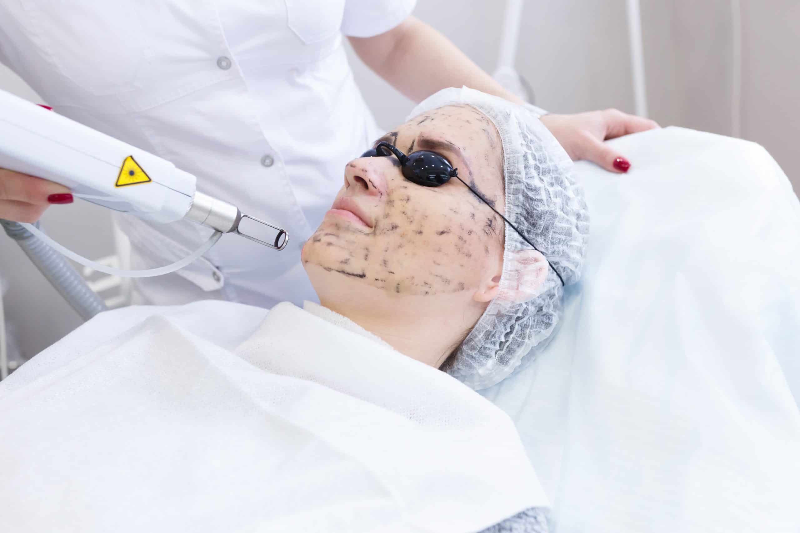 Different Types of Chemical Peels Which One is Right for You